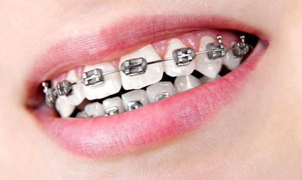 Budgeting Your Smile: Exploring Braces Costs in California