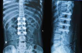 4 common types of spinal cord injuries