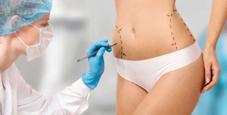 What Happens After You Get a Liposuction?